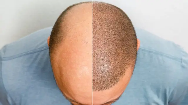 Imagem ilustrativa dividida: pessoa com parte sem cabelo e parte com cabelo